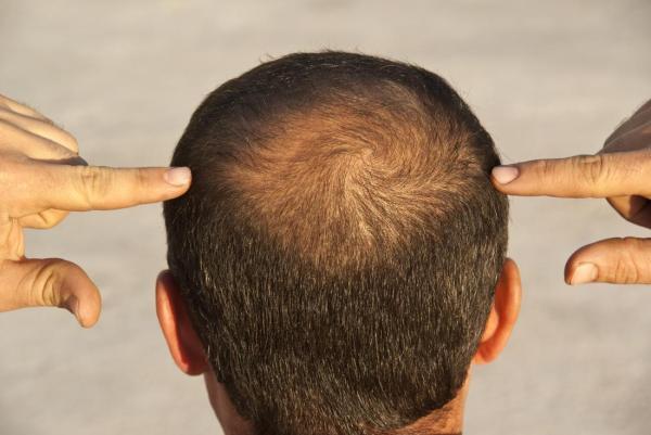 درمان نو ریزش موها: آزمایش دانشمندان بر روی یک دستگاه کوچک پوشیدنی